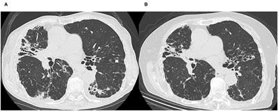 Case Report: Kampo Medicine for Non-tuberculous Mycobacterium Pulmonary Disease